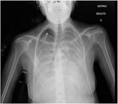 A complicated case of whole-lung lavage: a case report